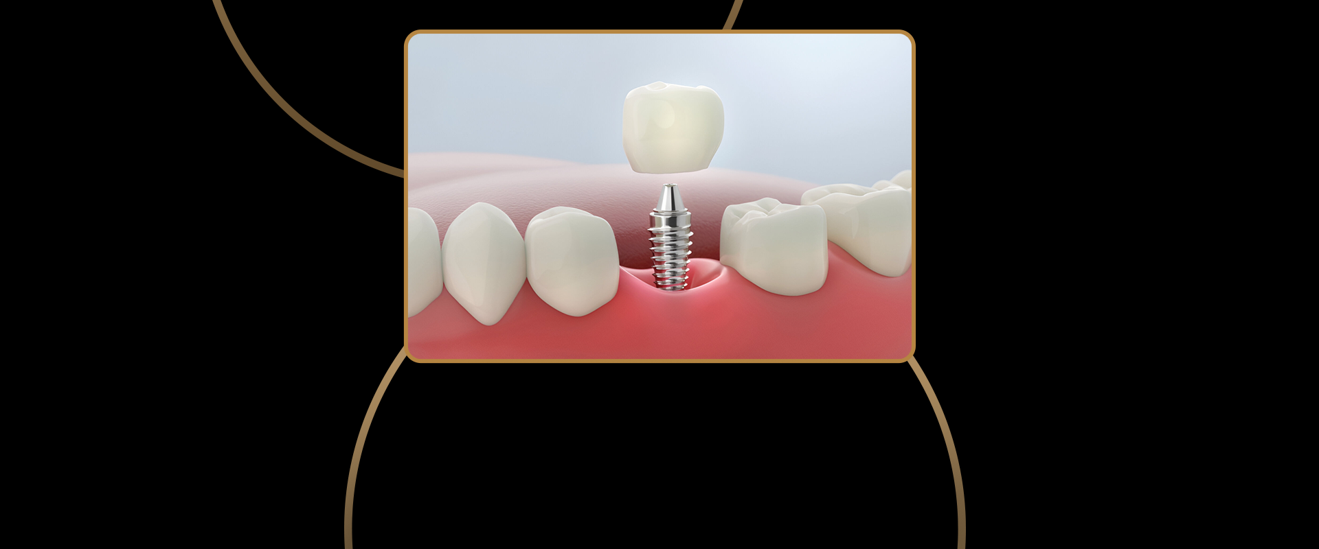 Single Tooth Dental Implants